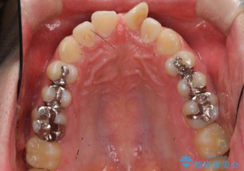 前歯のねじれ 上だけ部分矯正でコストダウンの治療前