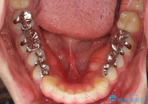 前歯のねじれ 上だけ部分矯正でコストダウンの治療前