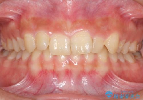 前歯のがたつき　過蓋咬合の症例 治療前