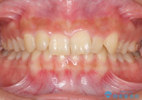 前歯のがたつき 過蓋咬合の症例 治療前