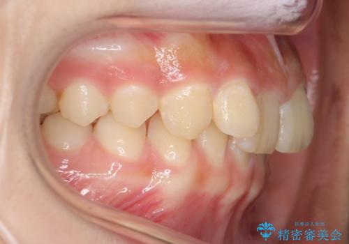 前歯のがたつき 過蓋咬合の治療前