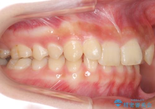 前歯のがたつき 過蓋咬合の治療前