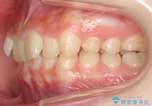 前歯のがたつき 過蓋咬合の治療前