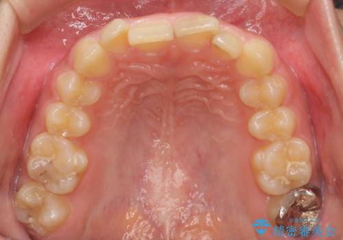 前歯のがたつき 過蓋咬合の治療前