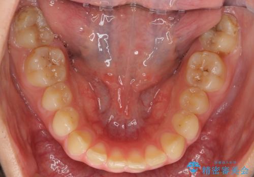 前歯のがたつき 過蓋咬合の治療前