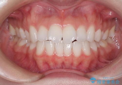 留学前に矯正治療 目立たないワイヤー装置でのスピード矯正の症例 治療前