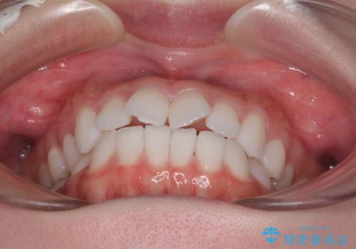 留学前に矯正治療 目立たないワイヤー装置でのスピード矯正の治療前