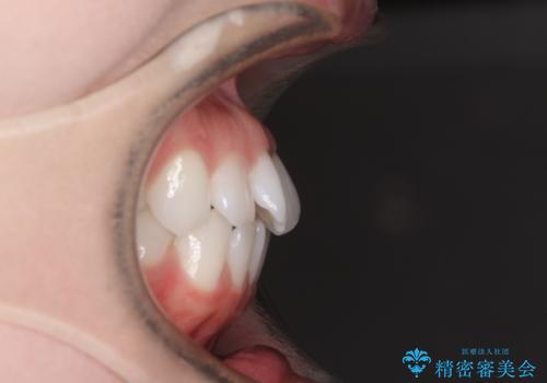 留学前に矯正治療 目立たないワイヤー装置でのスピード矯正の治療前