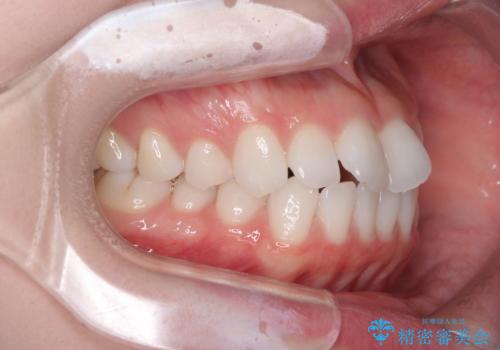 留学前に矯正治療 目立たないワイヤー装置でのスピード矯正の治療前