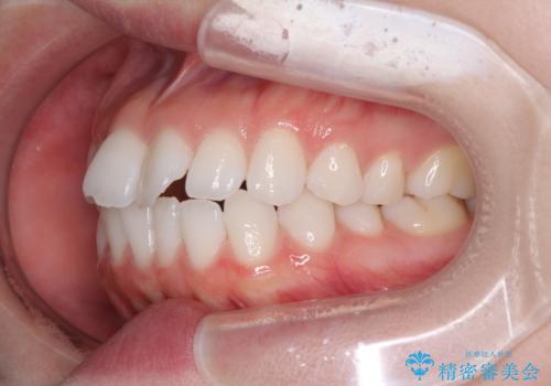 留学前に矯正治療 目立たないワイヤー装置でのスピード矯正の治療前