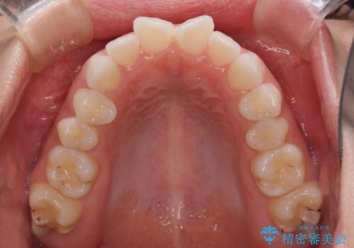 留学前に矯正治療 目立たないワイヤー装置でのスピード矯正の治療前