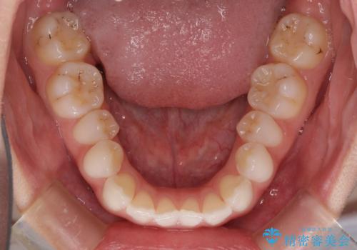 留学前に矯正治療 目立たないワイヤー装置でのスピード矯正の治療前