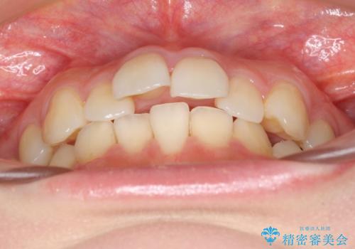 軽度の前歯のがたつき　下の前歯が生まれつき少ない