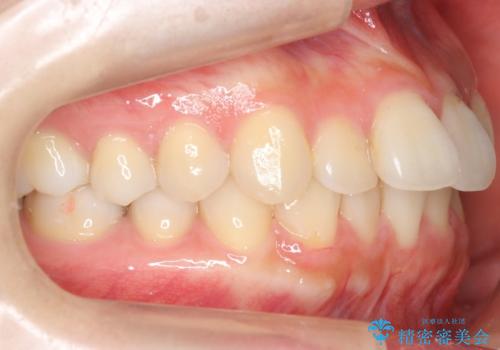 軽度の前歯のがたつき　下の前歯が生まれつき少ないの治療前