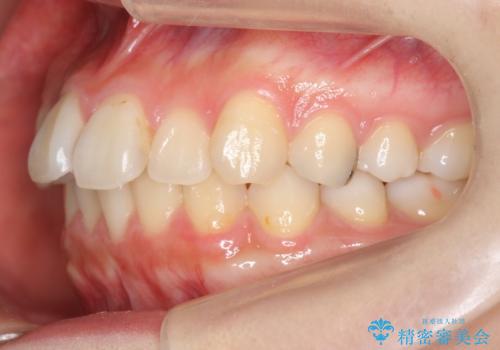 軽度の前歯のがたつき 下の前歯が生まれつき少ないの治療前