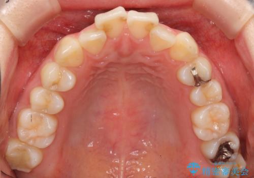 軽度の前歯のがたつき　下の前歯が生まれつき少ないの治療前