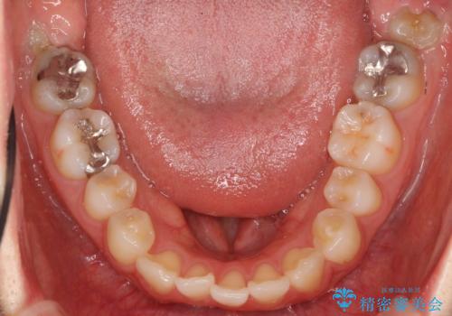 軽度の前歯のがたつき 下の前歯が生まれつき少ないの治療前