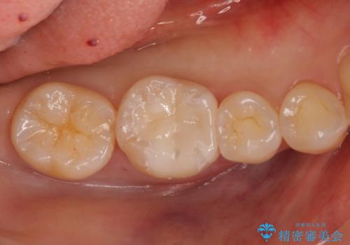 銀歯を白く セラミックインレーにの治療後