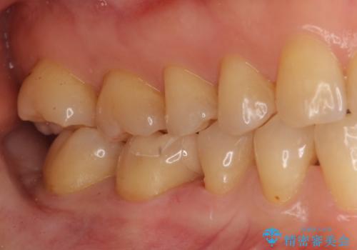 銀歯を白く セラミックインレーにの治療後