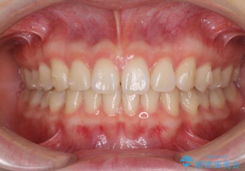 インビザラインによるすきっ歯の改善の治療中