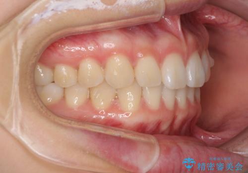 インビザラインによるすきっ歯の改善の治療中