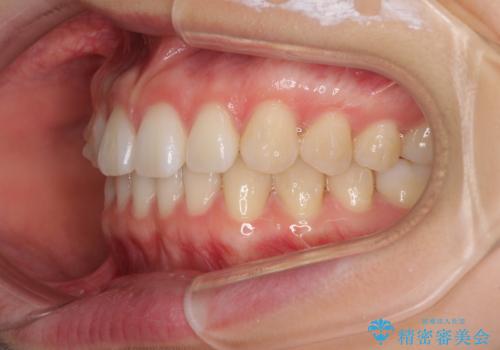 インビザラインによるすきっ歯の改善の治療中