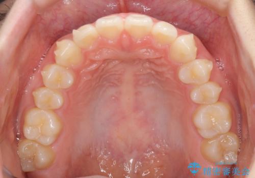 インビザラインによるすきっ歯の改善の治療中
