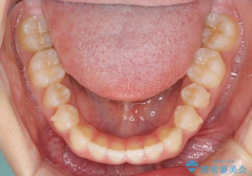 インビザラインによるすきっ歯の改善の治療中