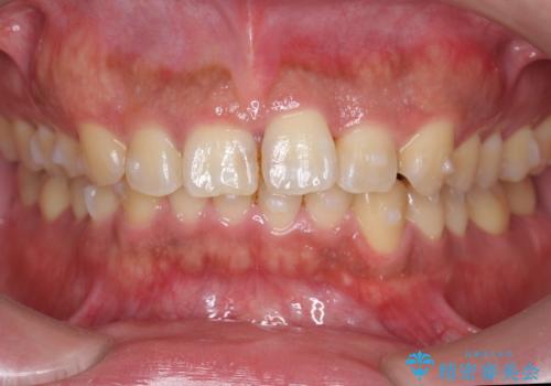 前歯のねじれを 1年かけずに矯正 インビザラインの治療中