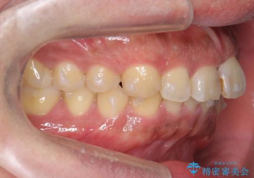 前歯のねじれを 1年かけずに矯正 インビザラインの治療中