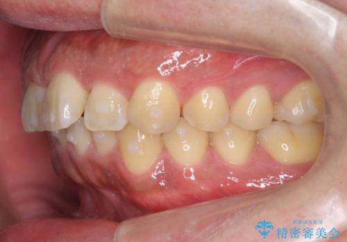 前歯のねじれを 1年かけずに矯正 インビザラインの治療中