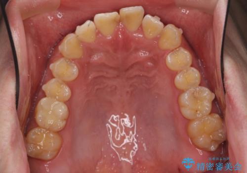 前歯のねじれを 1年かけずに矯正 インビザラインの治療中