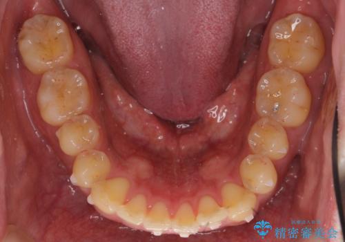 前歯のねじれを 1年かけずに矯正 インビザラインの治療中