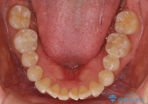 目立つ銀歯を全て白く　セラミックで虫歯治療の症例 治療後