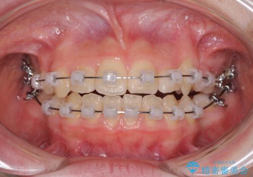 乳歯が残っている 目立たない装置での抜歯矯正の治療中