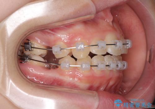 乳歯が残っている 目立たない装置での抜歯矯正の治療中