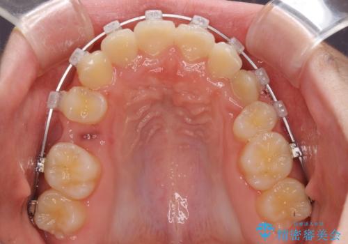 乳歯が残っている 目立たない装置での抜歯矯正の治療中
