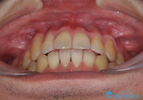 矯正歯科治療と前歯の歯肉移植術の治療後