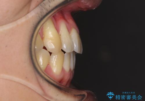 矯正歯科治療と前歯の歯肉移植術の治療後