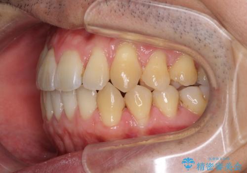 矯正歯科治療と前歯の歯肉移植術の治療後