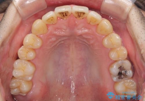 矯正歯科治療と前歯の歯肉移植術の治療後