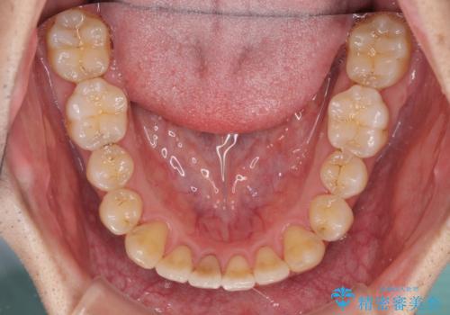 矯正歯科治療と前歯の歯肉移植術の治療後