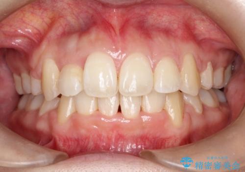 前歯が1本内側に引っ込んでいる　ワイヤーによる抜歯矯正の治療後