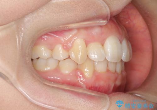 前歯が1本内側に引っ込んでいる ワイヤーによる抜歯矯正の治療後