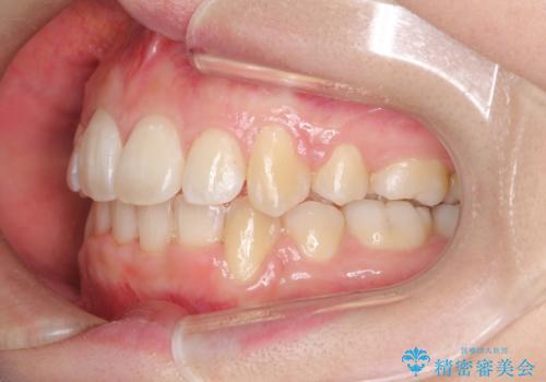 前歯が1本内側に引っ込んでいる　ワイヤーによる抜歯矯正の治療後