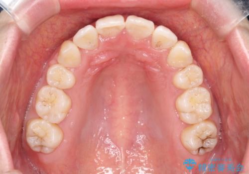 前歯が1本内側に引っ込んでいる ワイヤーによる抜歯矯正の治療後