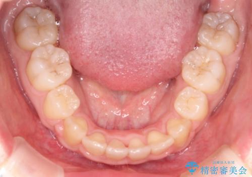 前歯が1本内側に引っ込んでいる ワイヤーによる抜歯矯正の治療後