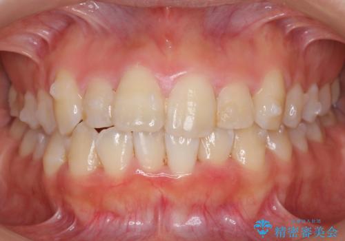 上下の前歯のがたつき 歯を抜かずに矯正の治療中