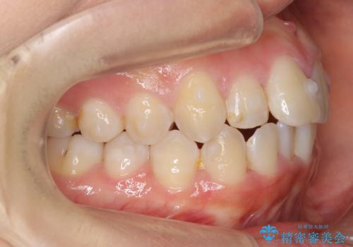 上下の前歯のがたつき 歯を抜かずに矯正の治療中