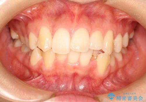 前歯が1本内側に引っ込んでいる ワイヤーによる抜歯矯正の症例 治療前